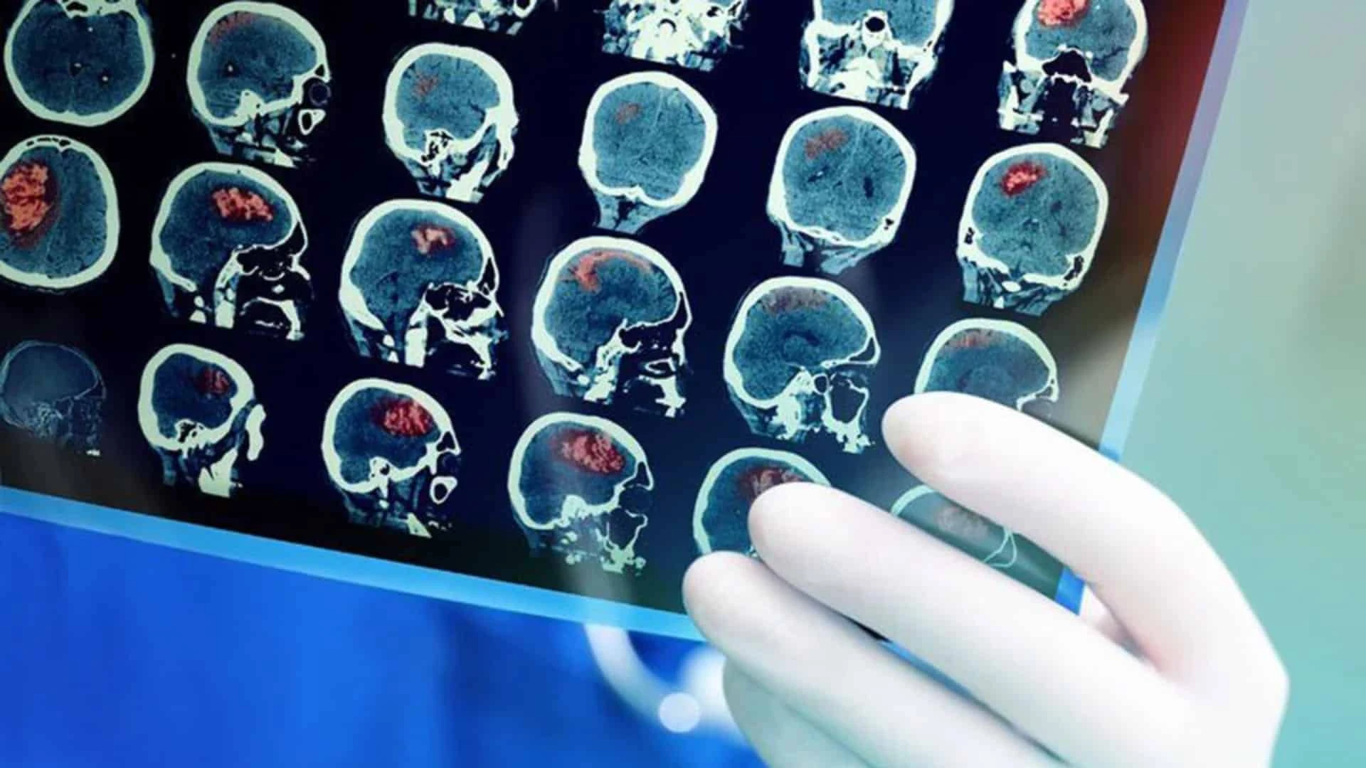 CNS Pharmaceuticals ищет лекарство от одного из самых агрессивных видов рака / Фото: shutterstock