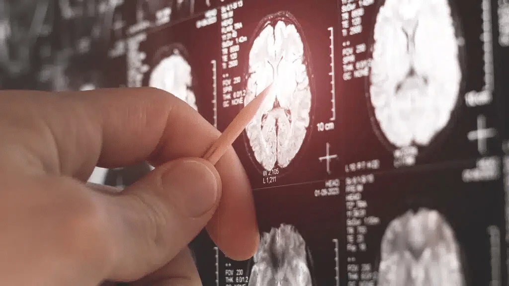 CNS Pharma is developing drugs to treat brain cancer / Photo: shutterstock